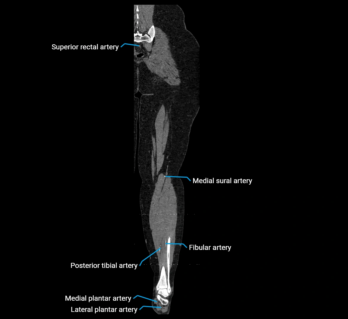 CTA lower limb coronal cross sectional anatomy labelled image _70 (2).webp